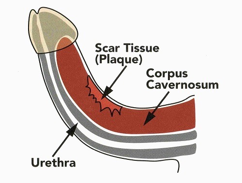 Peyronie's Disease Treatment Options