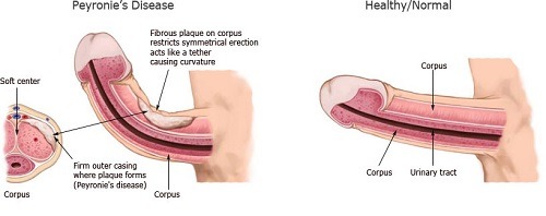 Penis with Peyronie's versus normal full