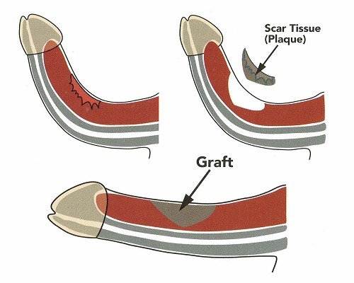 scar tissue treatment option