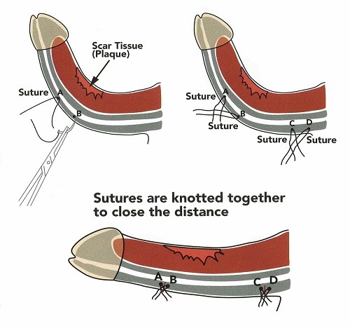 3 Techniques to make penis straight