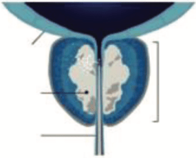 rezum-bladder-neck-incision-treatment