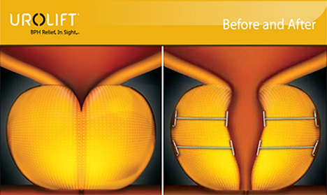 Urolift
