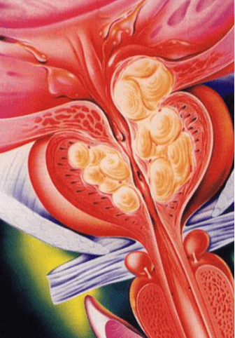 Bladder Neck Obstruction