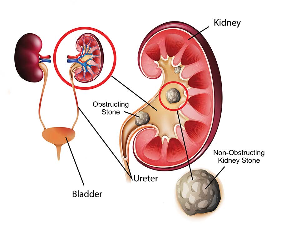 kidney stone diagram