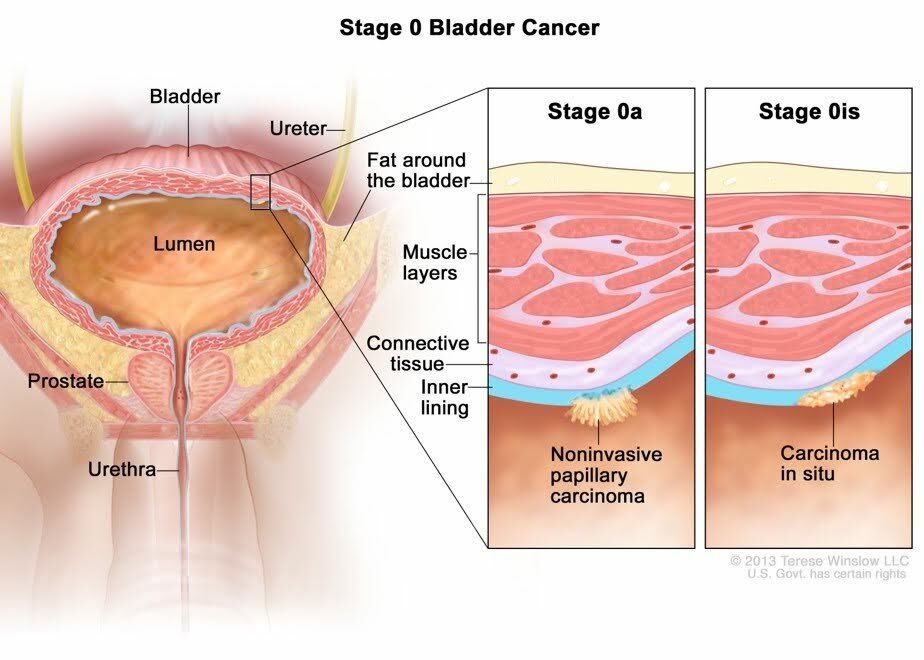 Stage 0 - Blabber Cancer Stage 0 - Blabber Cancer