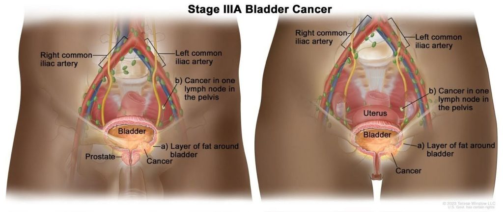 Stage 3A - Blabber Cancer Stage 3A - Blabber Cancer
