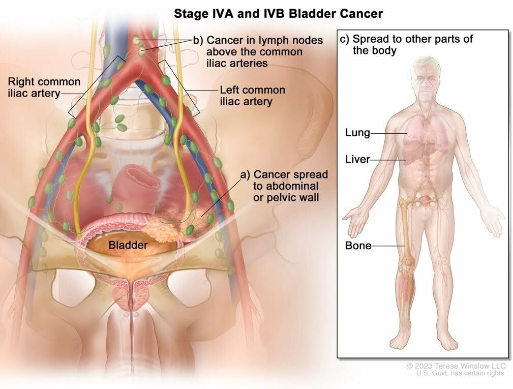 Stage 4A and B - Blabber Cancer Stage 4A and B - Blabber Cancer